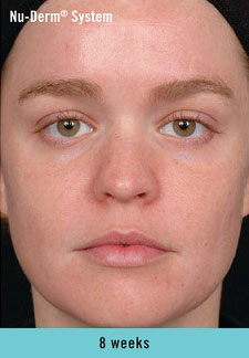 Photo of woman’s face after 8 weeks of using recommended skin care products