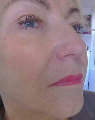 Photo of woman's eye after dermal filler treatment
