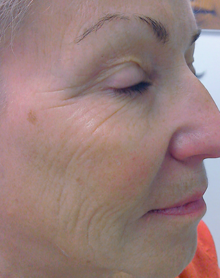 Photo of woman's eye lines before dermal filler treatment
