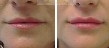 Front view photos of woman's lips after treatment