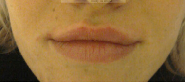 Photo of woman's lips after treatment
