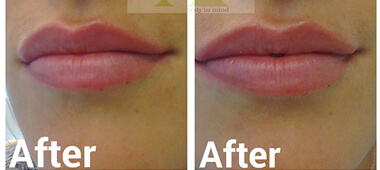 Photo's of woman's lips after treatment