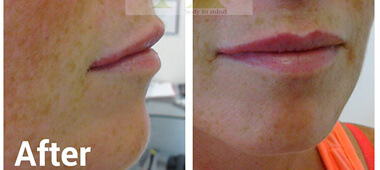 Front and side view photo's of woman's lips after treatment