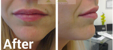 Front and side views of woman's lips after treatment