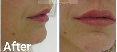 Side and front view photo's of woman's lips after treatment
