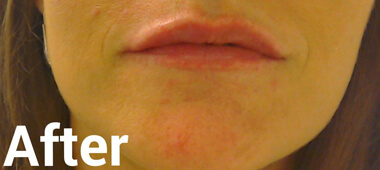 Photo of woman's lips after treatment