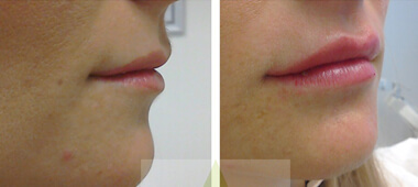 Photos of woman's lips side and front views before treatment