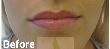 Photo of woman's lips before treatment