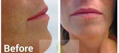 Front and side view photo's of woman's lips before treatment