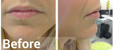 Front and side views of woman's lips before treatment