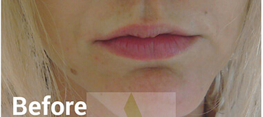 Photo of woman's lips before treatment