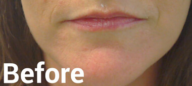 Photo of woman's lips before treatment