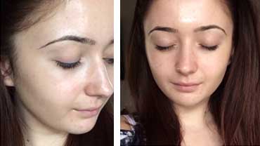 Side and front view photos of woman's face after treatment