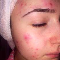 Photo of woman's face prior to treatment