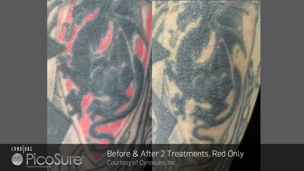 laser tattoo removal essex u0026 picosure laser tattoo removal essex laser tattoo removal essex u0026 picosure laser tattoo removal essex