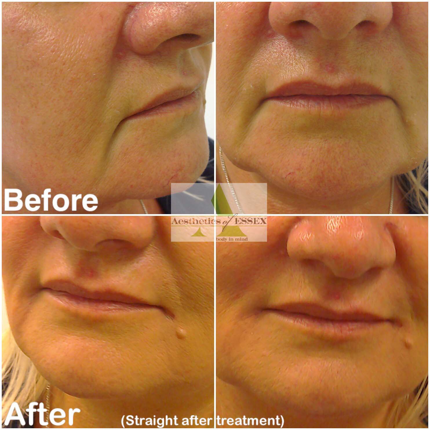 Dermal Fillers Aesthetics of Essex