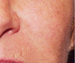 Photo of cheek without spider veins showing after treatment