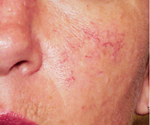 Photo of cheek with spider veins showing before treatment
