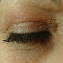 after eye bag remvoal
