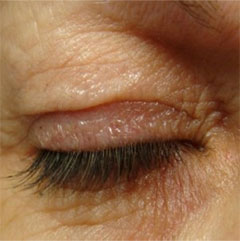 before eye bag removal
